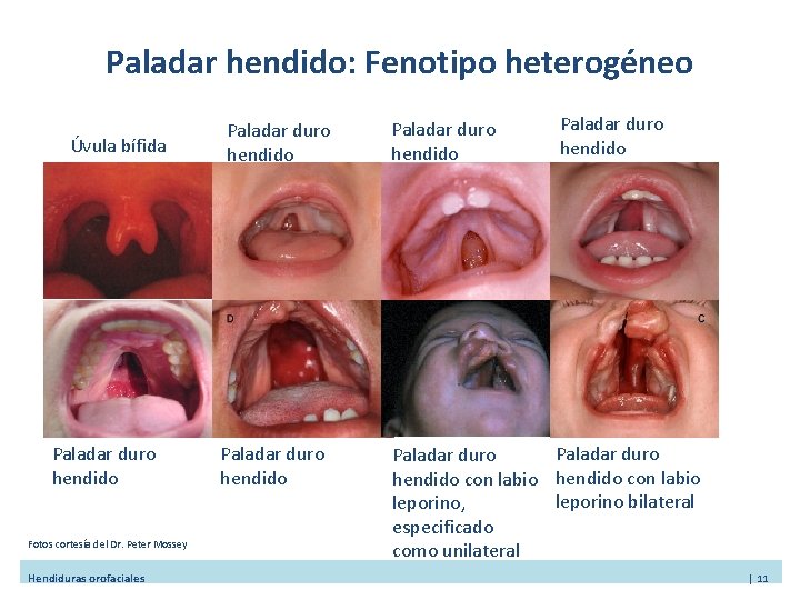 Paladar hendido: Fenotipo heterogéneo Úvula bífida Paladar duro hendido Fotos cortesía del Dr. Peter