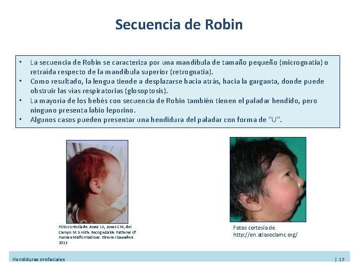 Secuencia de Robin • • La secuencia de Robin se caracteriza por una mandíbula