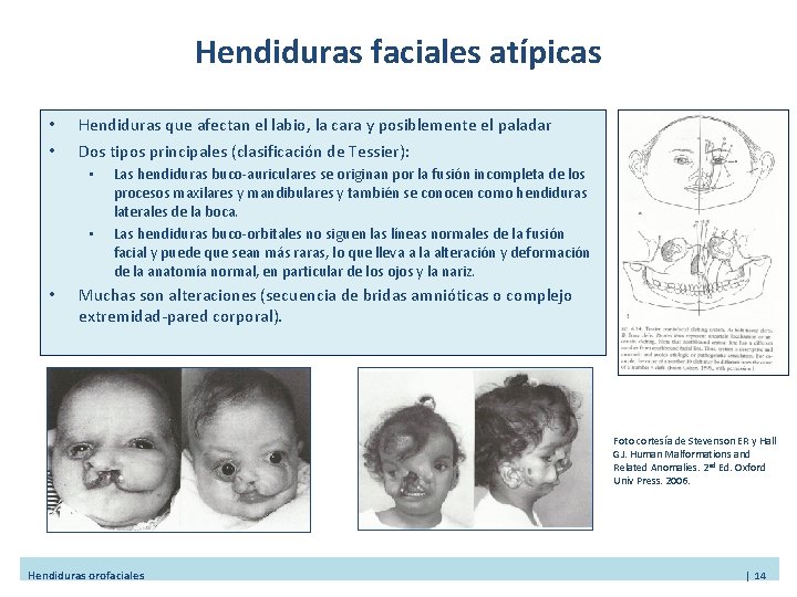 Hendiduras faciales atípicas • • Hendiduras que afectan el labio, la cara y posiblemente