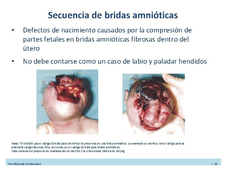 Secuencia de bridas amnióticas • Defectos de nacimiento causados por la compresión de partes