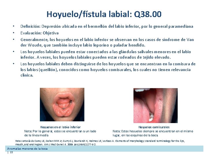 Hoyuelo/fístula labial: Q 38. 00 • • • Definición: Depresión ubicada en el bermellón