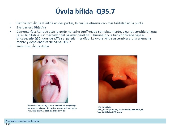 Úvula bífida Q 35. 7 • • Definición: Úvula dividida en dos partes, lo