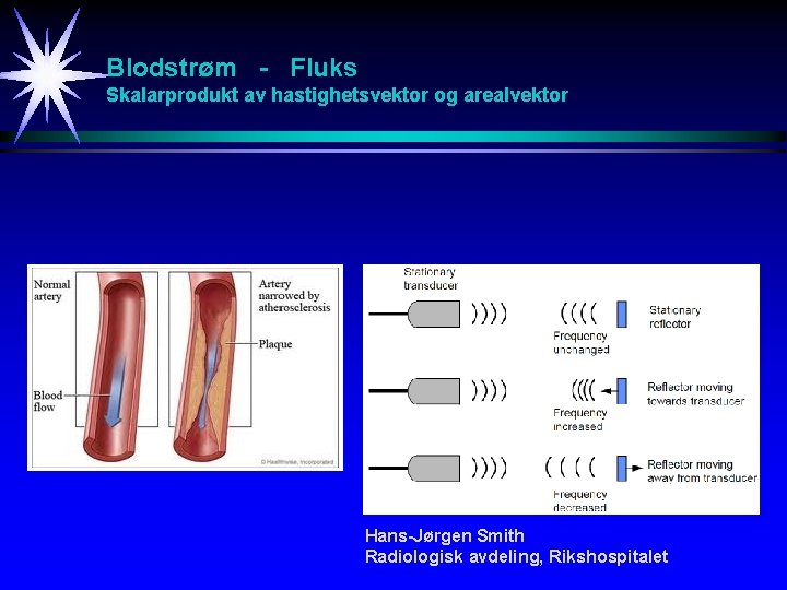 Blodstrøm - Fluks Skalarprodukt av hastighetsvektor og arealvektor Hans-Jørgen Smith Radiologisk avdeling, Rikshospitalet 