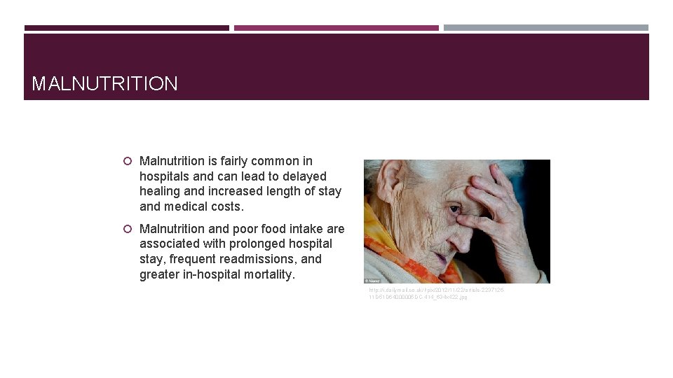 MALNUTRITION Malnutrition is fairly common in hospitals and can lead to delayed healing and