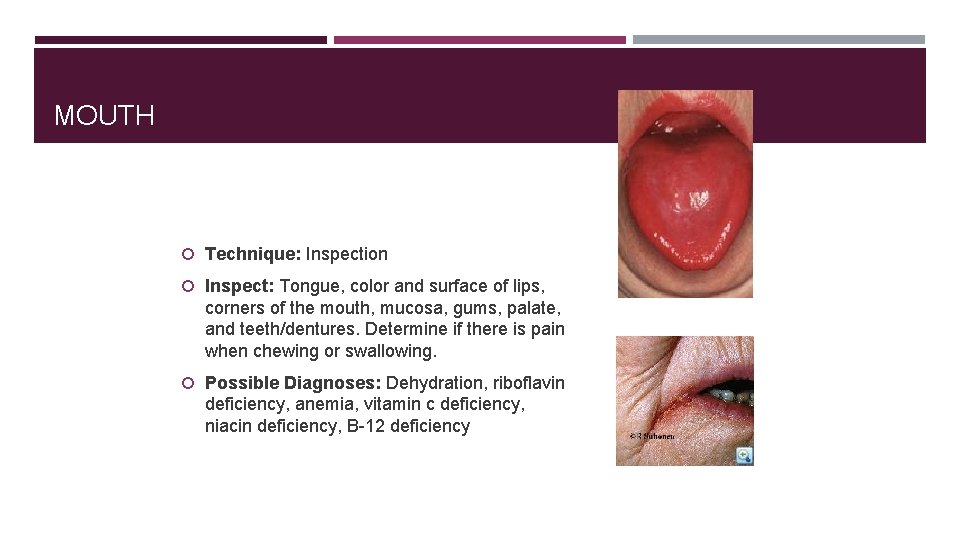 MOUTH Technique: Inspection Inspect: Tongue, color and surface of lips, corners of the mouth,