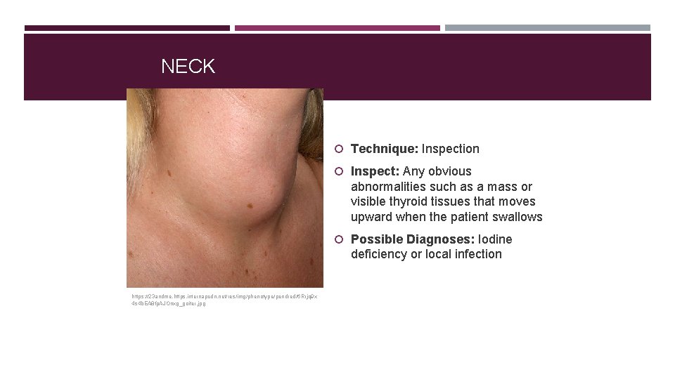 NECK Technique: Inspection Inspect: Any obvious abnormalities such as a mass or visible thyroid