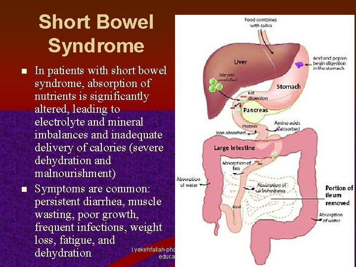 Short Bowel Syndrome n n In patients with short bowel syndrome, absorption of nutrients