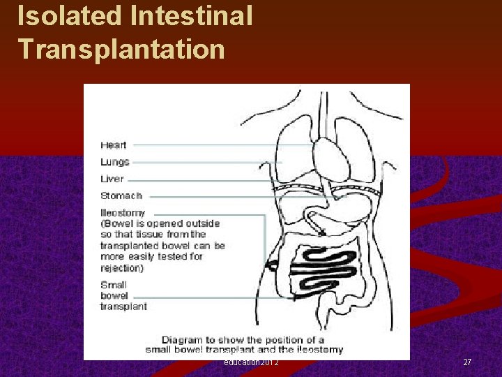 Isolated Intestinal Transplantation l. yekehfallah-phd student of nursing education 2012 27 