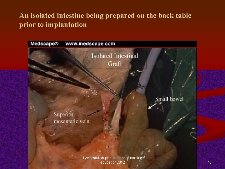 An isolated intestine being prepared on the back table prior to implantation l. yekehfallah-phd