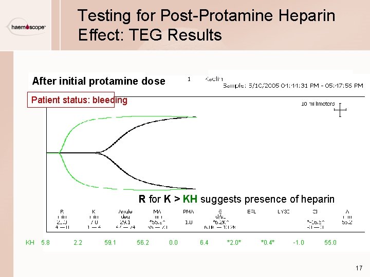 Testing for Post-Protamine Heparin Effect: TEG Results After initial protamine dose Patient status: bleeding
