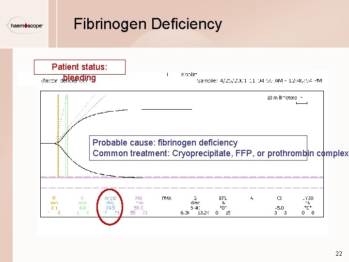 Fibrinogen Deficiency Patient status: bleeding Probable cause: fibrinogen deficiency Common treatment: Cryoprecipitate, FFP, or