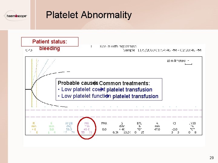 Platelet Abnormality Patient status: bleeding Probable causes Common treatments: • Low platelet count platelet