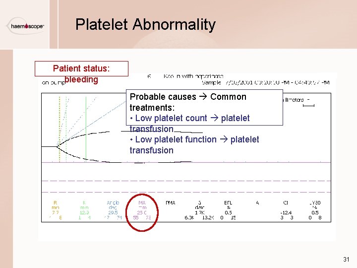 Platelet Abnormality Patient status: bleeding Probable causes Common treatments: • Low platelet count platelet