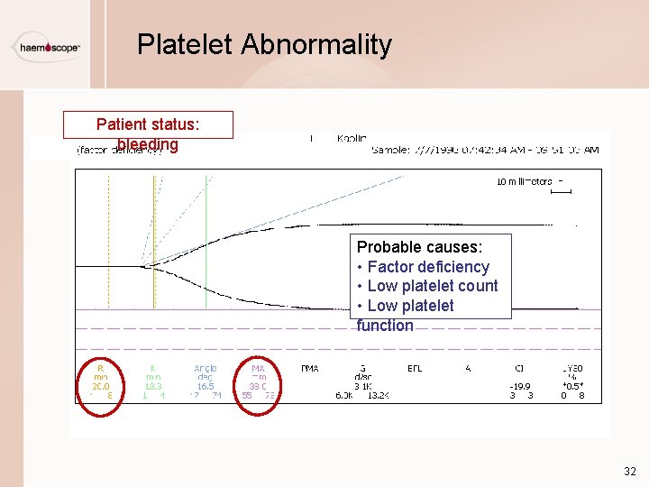 Platelet Abnormality Patient status: bleeding Probable causes: • Factor deficiency • Low platelet count