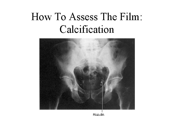 How To Assess The Film: Calcification 