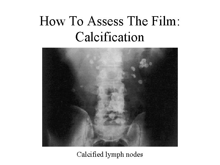 How To Assess The Film: Calcification Calcified lymph nodes 