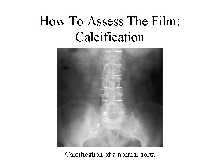 How To Assess The Film: Calcification of a normal aorta 