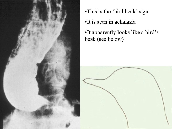  • This is the ‘bird beak’ sign • It is seen in achalasia