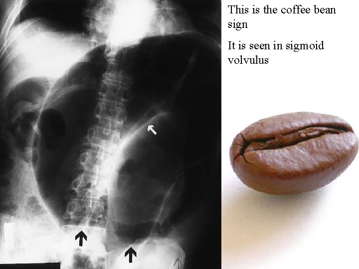 This is the coffee bean sign It is seen in sigmoid volvulus 