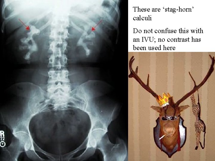 These are ‘stag-horn’ calculi Do not confuse this with an IVU; no contrast has