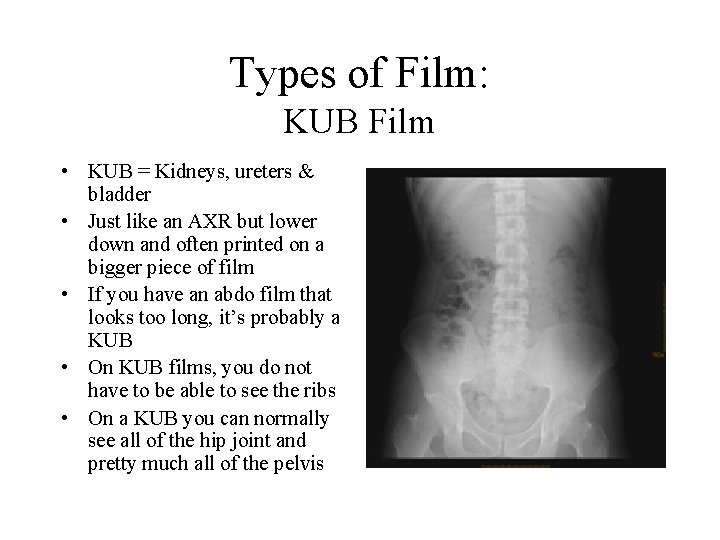 Types of Film: KUB Film • KUB = Kidneys, ureters & bladder • Just