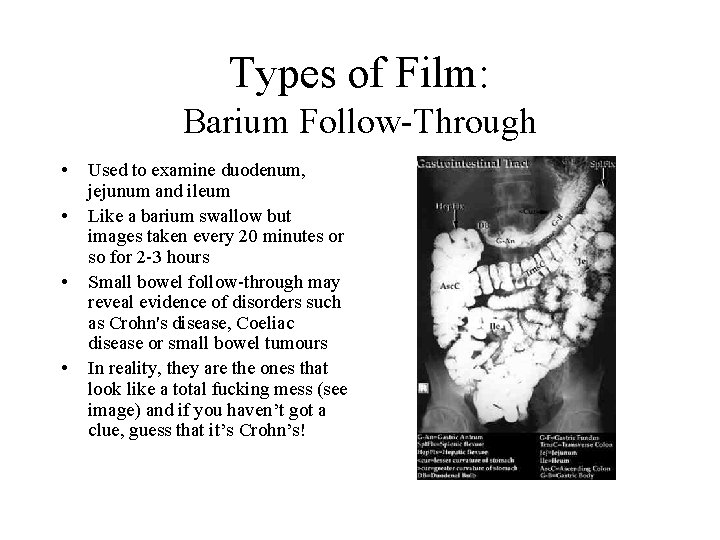 Types of Film: Barium Follow-Through • • Used to examine duodenum, jejunum and ileum