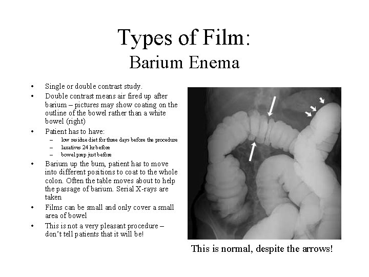 Types of Film: Barium Enema • • • Single or double contrast study. Double