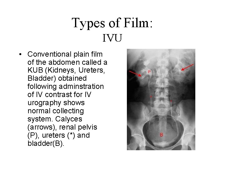 Types of Film: IVU • Conventional plain film of the abdomen called a KUB