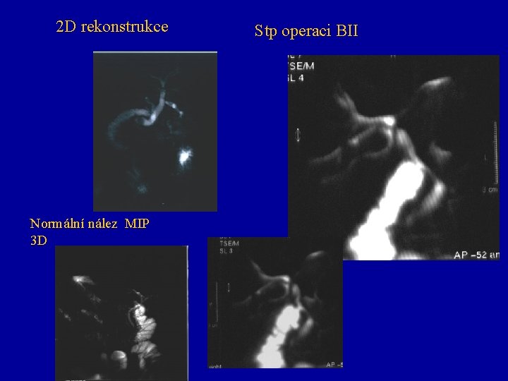 2 D rekonstrukce Normální nález MIP 3 D Stp operaci BII 