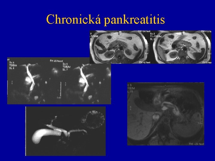 Chronická pankreatitis 