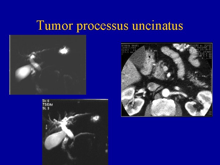 Tumor processus uncinatus 