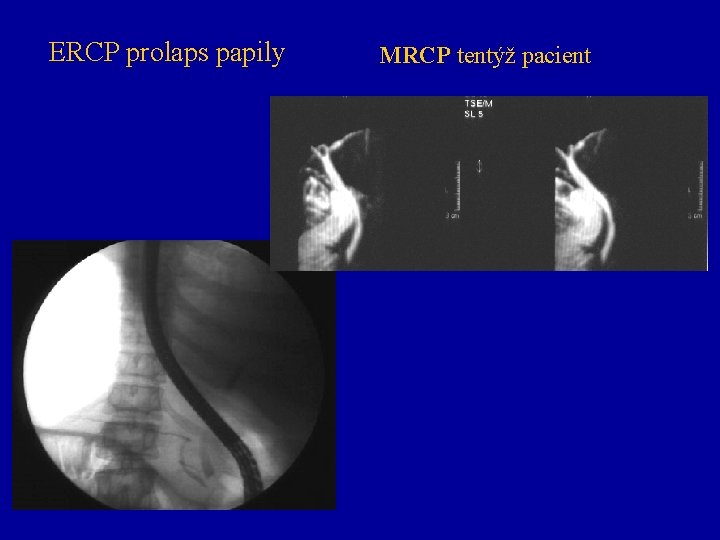 ERCP prolaps papily MRCP tentýž pacient 