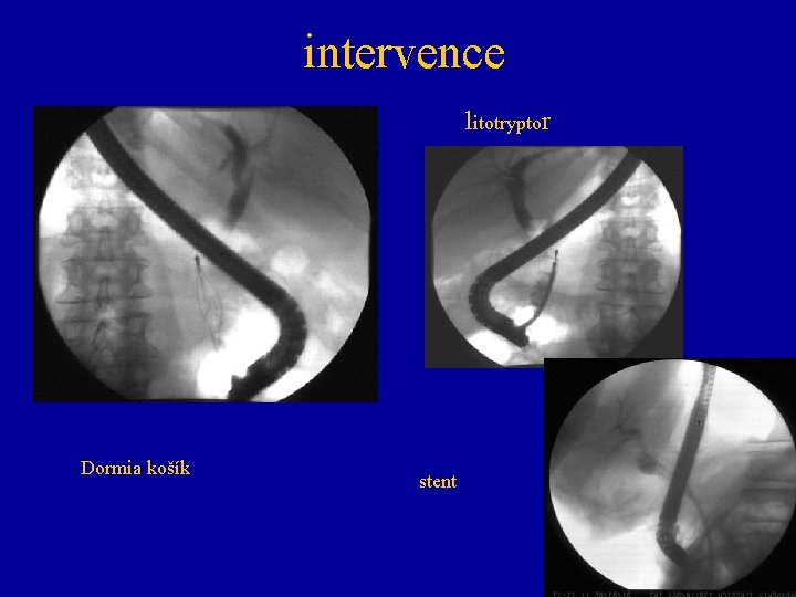 intervence litotryptor Dormia košík stent 