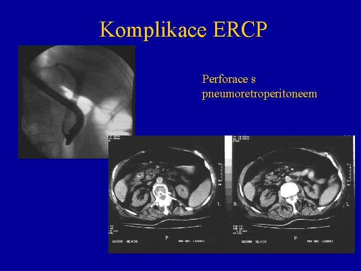 Komplikace ERCP Perforace s pneumoretroperitoneem 