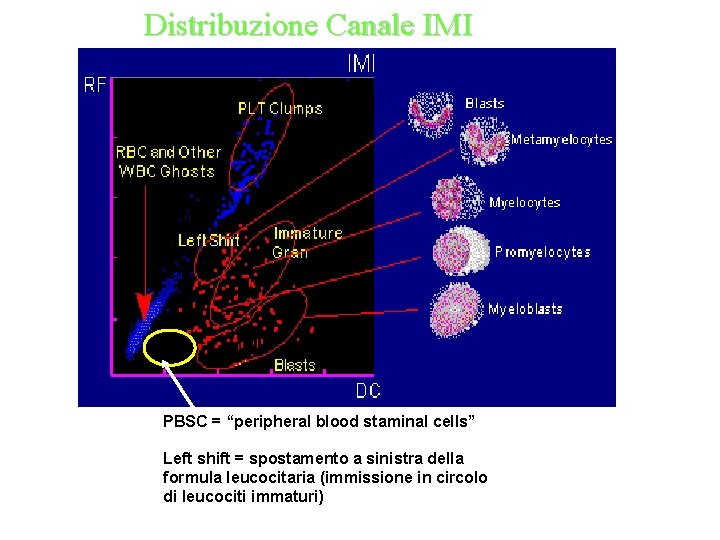 Distribuzione Canale IMI PBSC = “peripheral blood staminal cells” Left shift = spostamento a