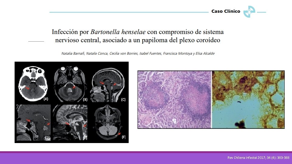 Rev Chilena Infectol 2017; 34 (4): 383 -388 