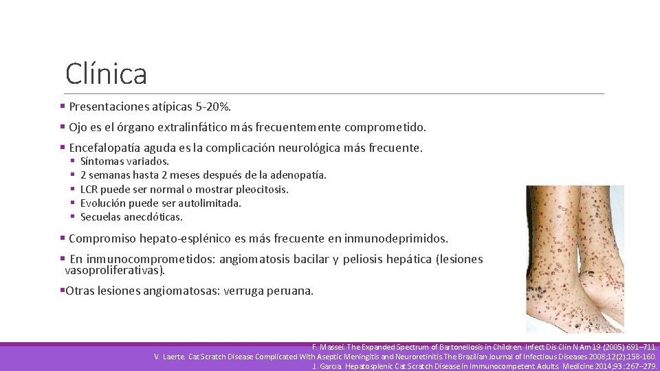 Clínica § Presentaciones atípicas 5 -20%. § Ojo es el órgano extralinfático más frecuentemente