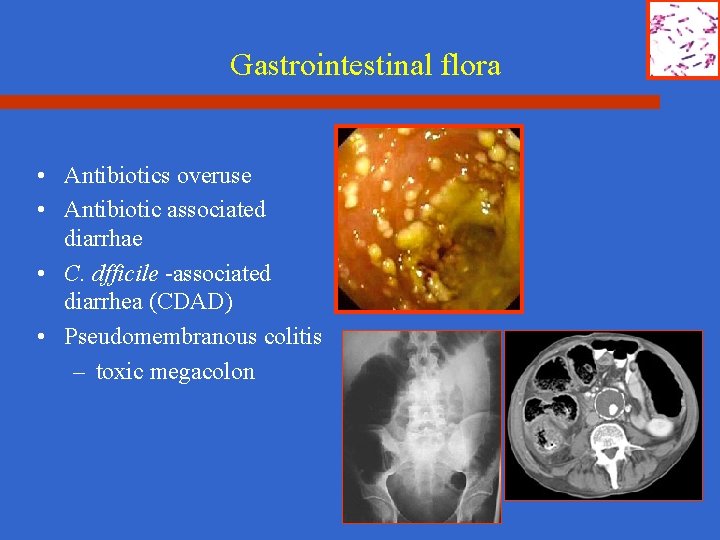 Gastrointestinal flora • Antibiotics overuse • Antibiotic associated diarrhae • C. dfficile -associated diarrhea