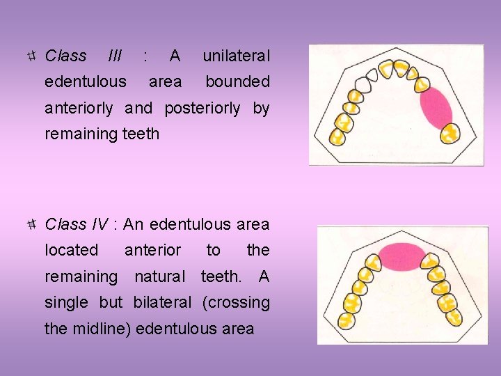 Class III : edentulous A unilateral area bounded anteriorly and posteriorly by remaining teeth