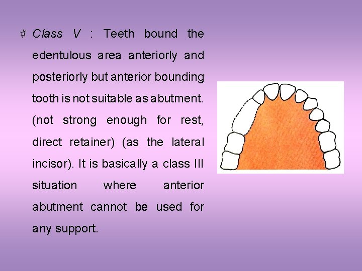 Class V : Teeth bound the edentulous area anteriorly and posteriorly but anterior bounding