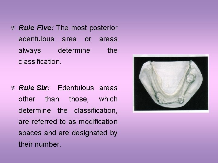 Rule Five: The most posterior edentulous always area or areas determine the classification. Rule