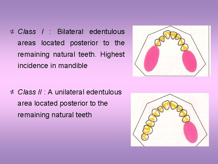 Class I : Bilateral edentulous areas located posterior to the remaining natural teeth. Highest