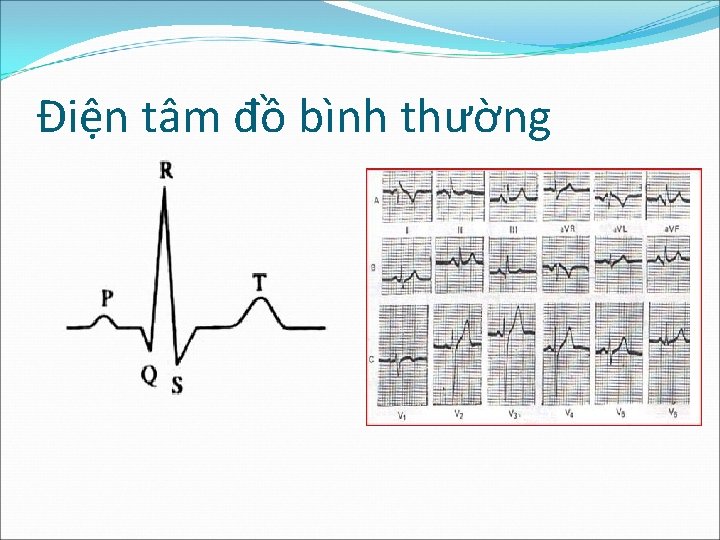 Điện tâm đồ bình thường 