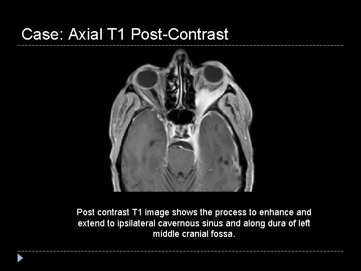 Case: Axial T 1 Post-Contrast Post contrast T 1 image shows the process to