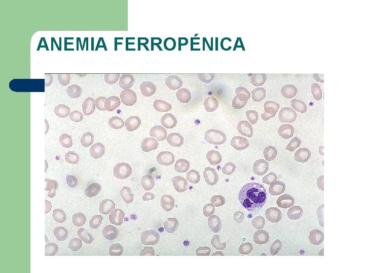 ANEMIA FERROPÉNICA 