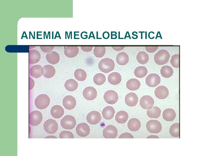 ANEMIA MEGALOBLASTICA 