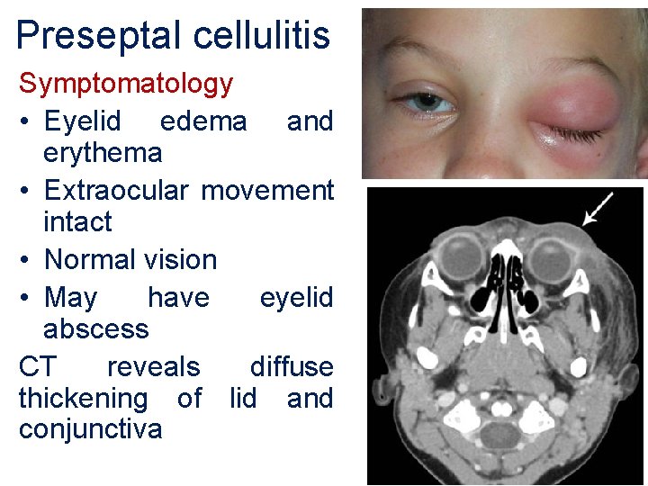 Preseptal cellulitis Symptomatology • Eyelid edema and erythema • Extraocular movement intact • Normal