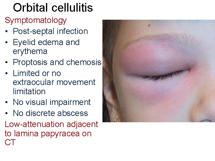 Orbital cellulitis Symptomatology • Post-septal infection • Eyelid edema and erythema • Proptosis and