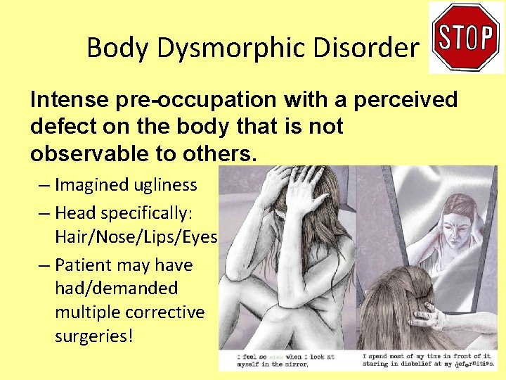 Body Dysmorphic Disorder Intense pre-occupation with a perceived defect on the body that is