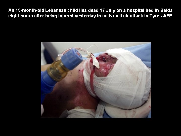 An 18 -month-old Lebanese child lies dead 17 July on a hospital bed in